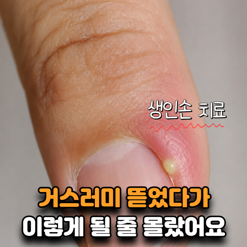 “손톱 옆이 욱신거리더니 고름까지 찼어요” 생인손 치료과정