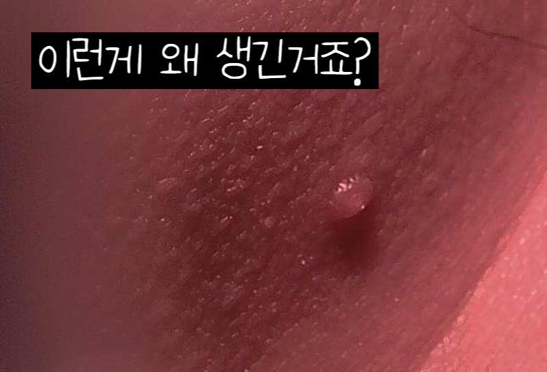 성인 물사마귀 제거 후 재발하는 원인, 치료, 예방
