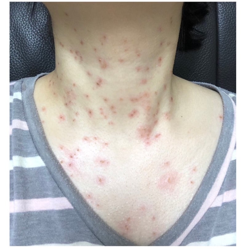 편평사마귀란? 한의원부터 피부과까지 다녀본 솔직 후기