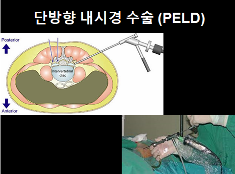 허리디스크 척추내시경 수술