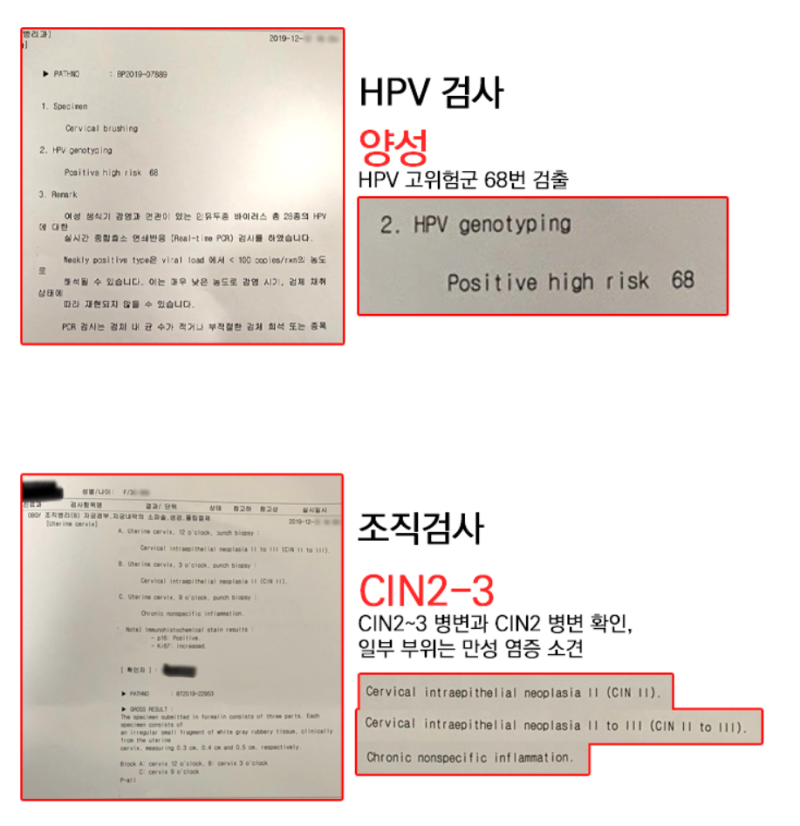 자궁경부이형성증 CIN1·2·3, 면역을 통한 HPV 바이러스 소멸 조건 총정리