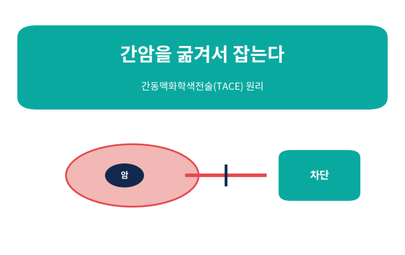 간암을 굶겨서 잡는다? 간동맥화학색전술 원리 쉽게 정리