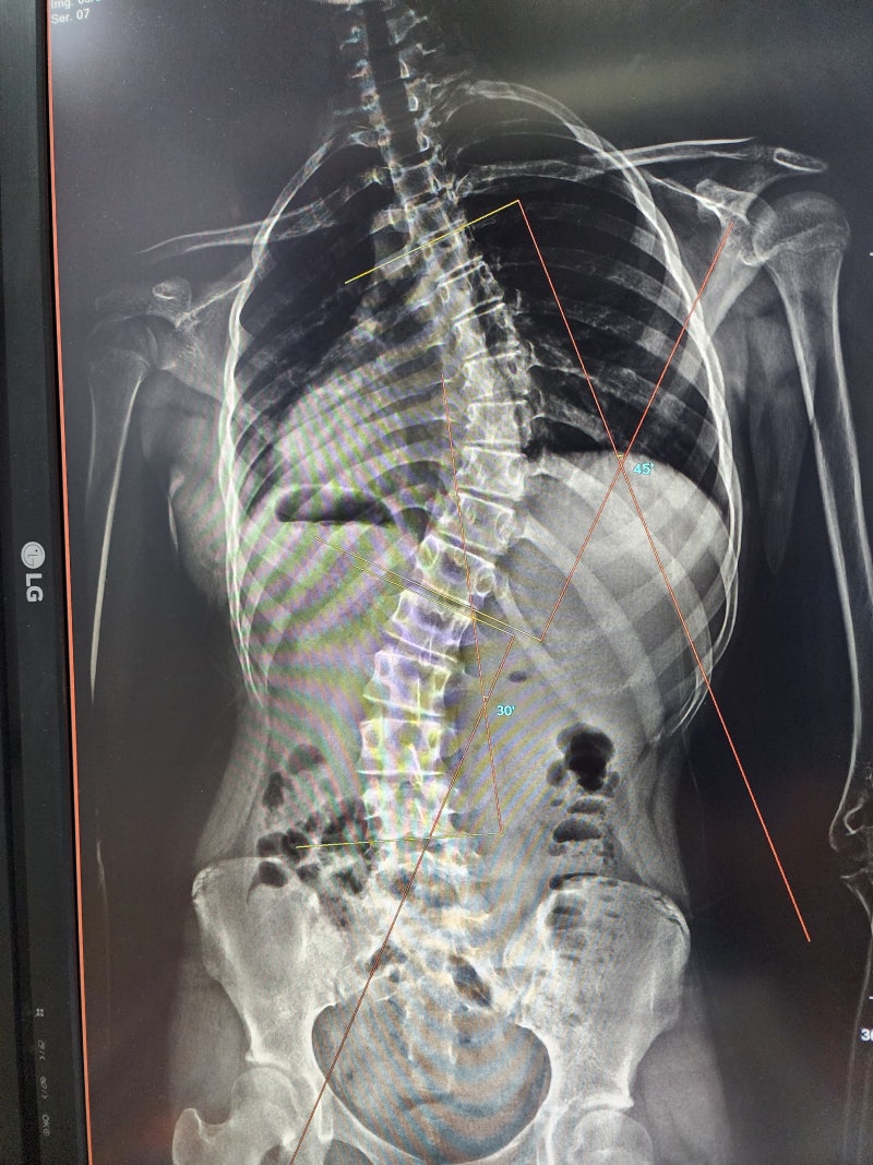 광주 척추측만증 물리치료 없이 바로 비급여 도수치료 가능