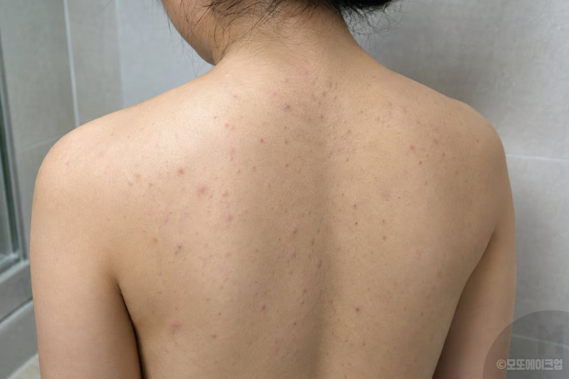 가드름 등드름 원인, 매일 씻는데 왜 생길까