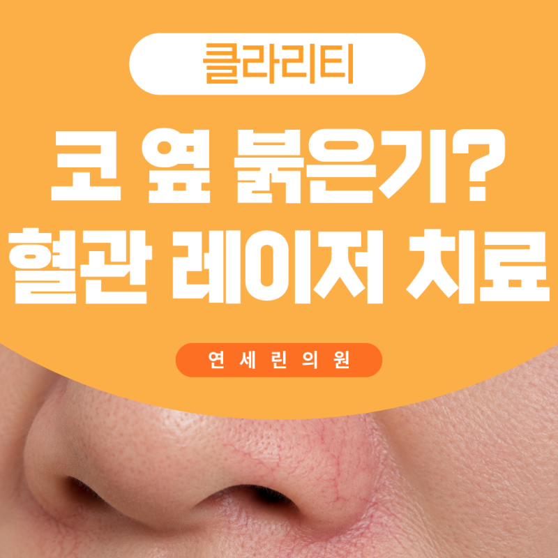 코 옆 붉은기? 혈관 비침 클라리티 레이저 치료