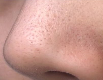 [코피지제거, 코피지녹이기, 블랙헤드제거, 블랙헤드없애는법] 코 피지 억지로 뜯으면 모공 ....