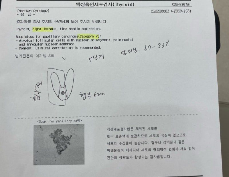 갑상선암 수술해야될까? 건강검진 후 갑상선 유두암 5단계 진단