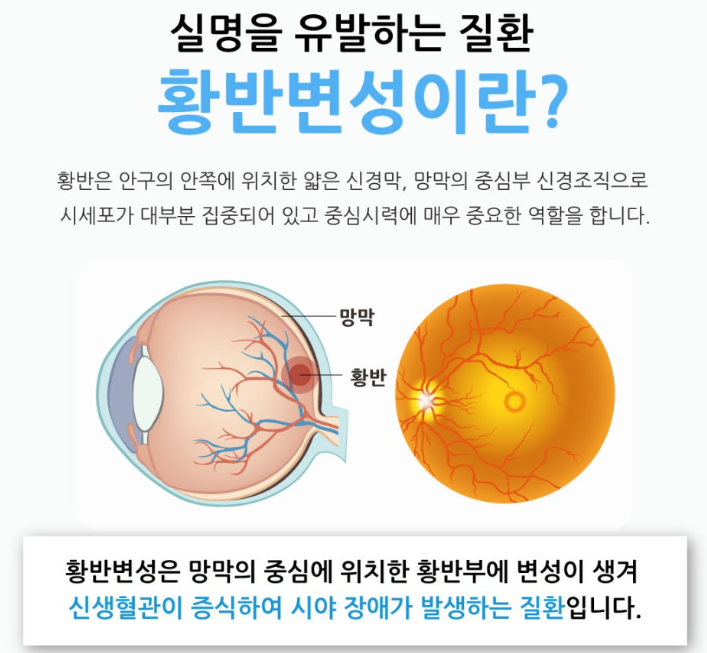 [황반변성] 개요, wAMD GA