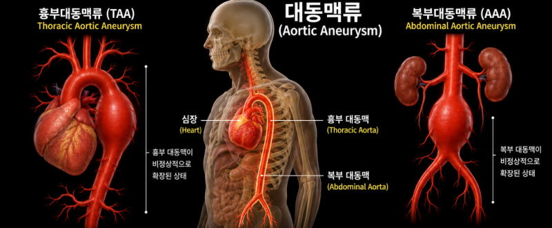 [성인간호학] 105. 대동맥류(Aortic Aneurysm)