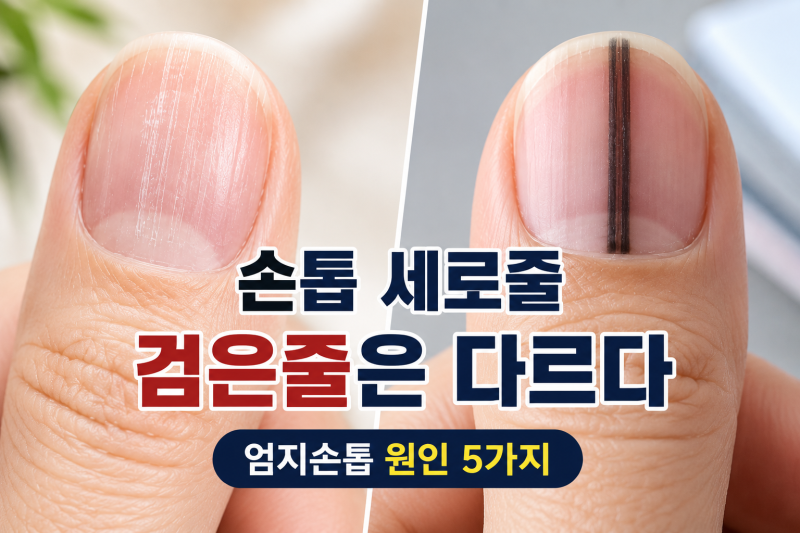 손톱 세로줄 검은줄 원인 5가지 엄지손톱 울퉁불퉁 갈라짐까지