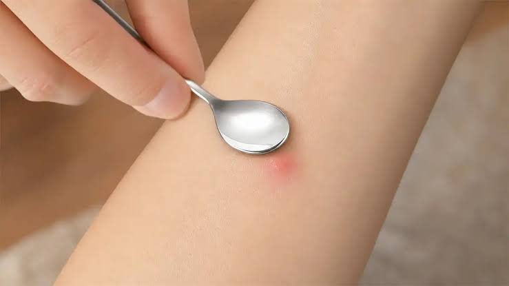 모기에 물렸을 때 붓기와 가려움을 빠르게 완화할 수 있는 응급처치 및 치료 방법