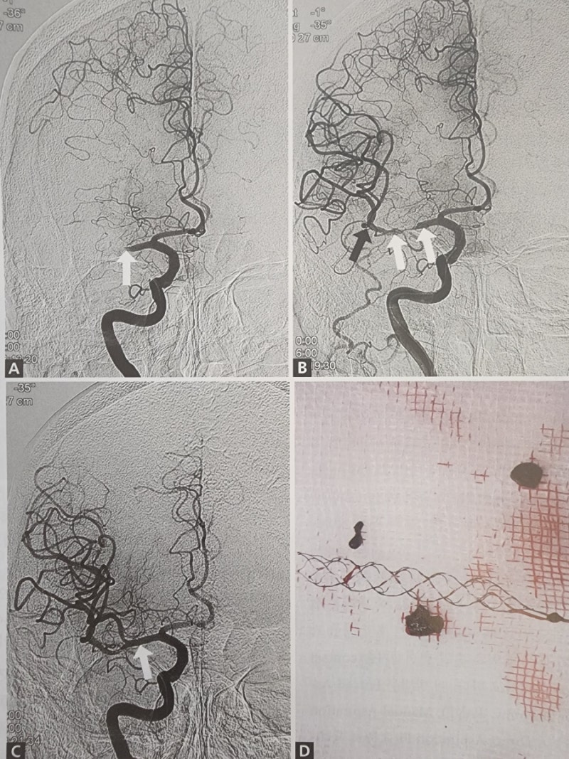 Acute Ischemic Stroke & Mechanical Thrombectomy 급성 허혈성 뇌졸중과 기계적 혈전 제거술