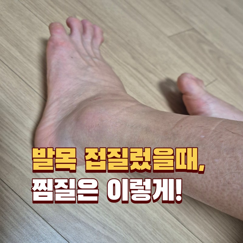 발목 접질렀을 때 찜질은? 붓기 있을 때 제가 한 3가지