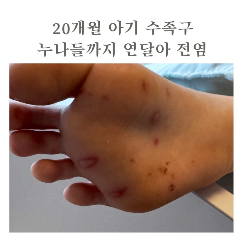 20개월 아기 수족구, 초등학생 누나들까지 연달아 전염된 한 달 기록