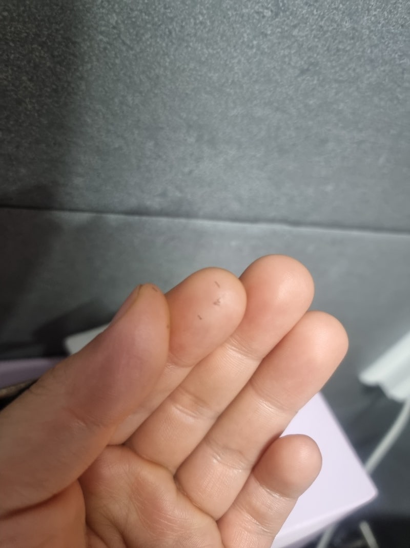 [수염 제모 5회차] 마흔을 바라보는 아빠의 솔직한 레이저 제모 후기 (고통, 만족도, 흰 수염....