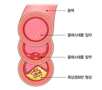 고지혈증 약 '스타틴(Statin)'의 작용 원리와 부작용(근육통) 대처 가이드
