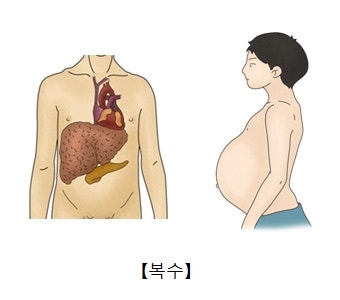 간경화의 무서운 합병증 3가지: 복수(Ascites)·황달·식도정맥류 위험성