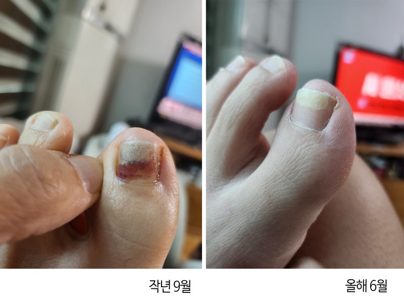 발톱무좀은 정말 전염 안되는 것인가?