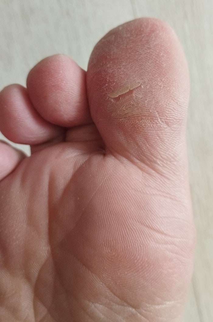 발가락이 갈라지고 통증이 있다면..