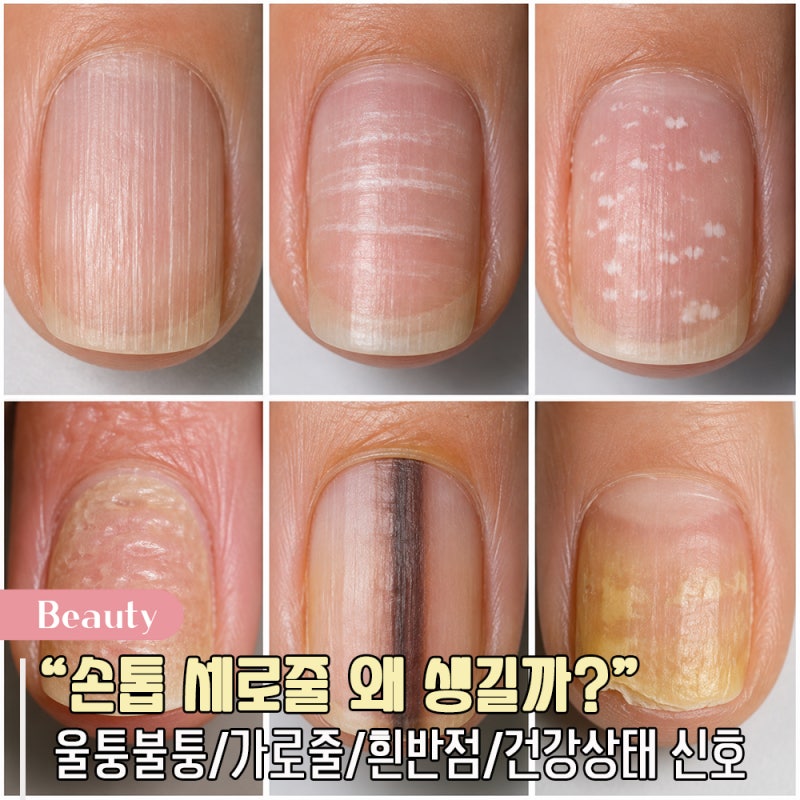 손톱 세로줄 왜 생길까? 울퉁불퉁 가로줄 흰반점 건강상태 신호 체크