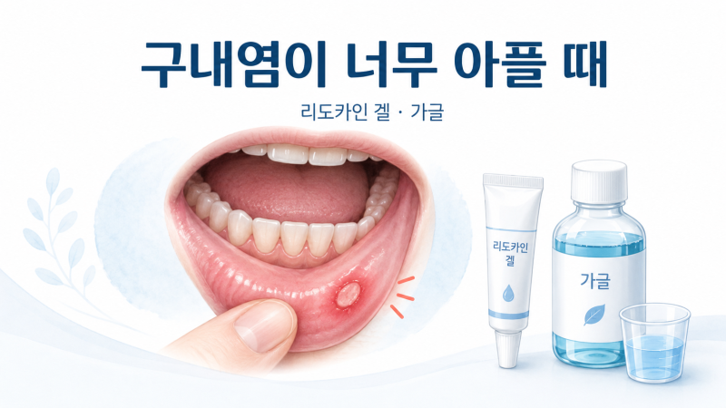 구내염 약 (4) 구내염이 너무 아플 때 쓰는 약 | 리도카인 겔과 가글 차이