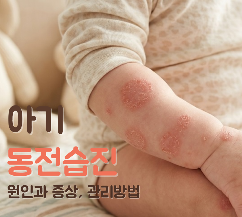 아기 동전습진 원인과 증상, 아토피 차이점은 뭘까?