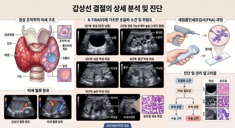갑상선 결절