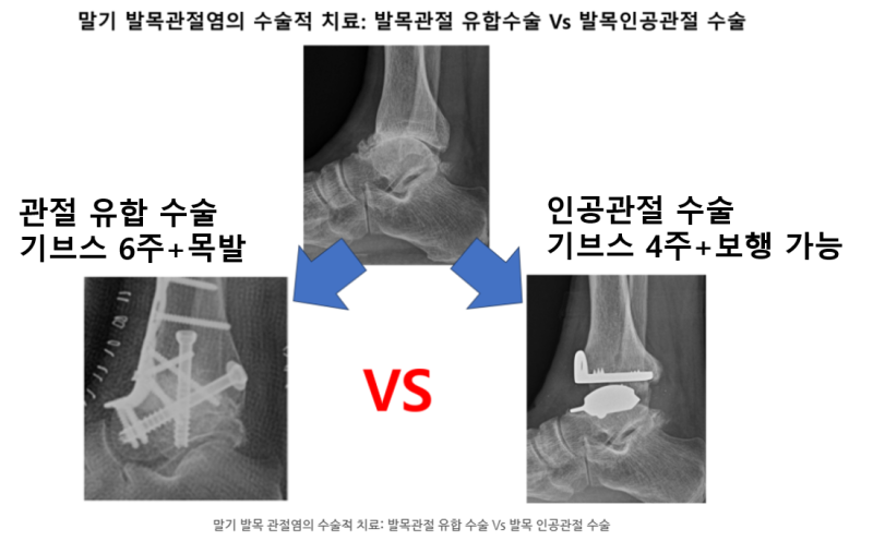 오목발과 발목 불안정성으로 인한 말기 발목 관절염의 인공관절 수술사례: 일이 많아서 빨리....
