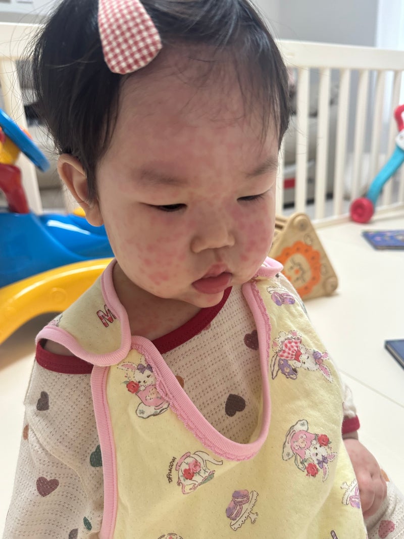 아기 돌발진, 언제 걸리고 열은 며칠이나 갈까? 증상부터 홈케어까지 총정리