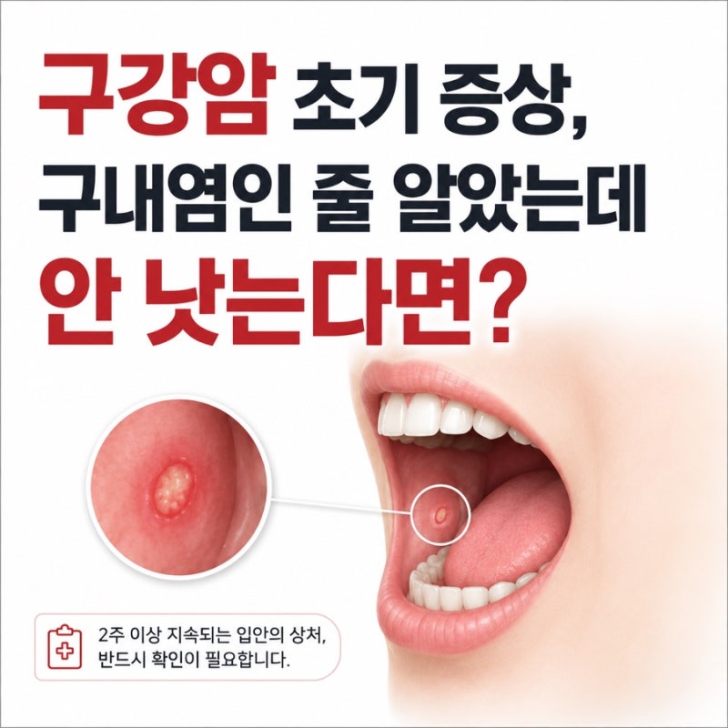 구강암 초기 증상 구내염 차이 확실히 구별하는 방법