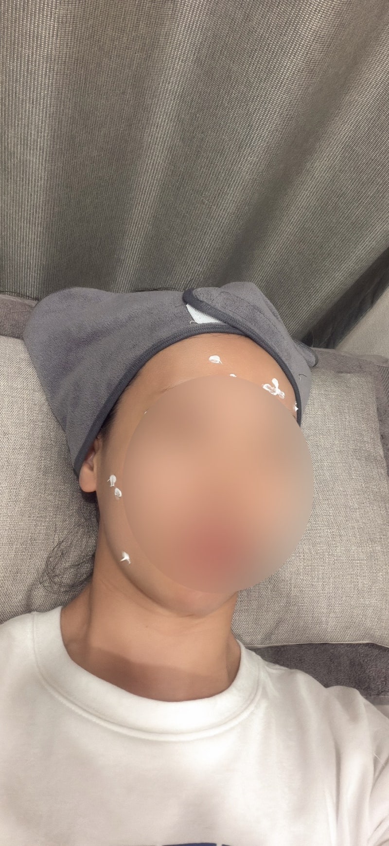 편평사마귀 제거 후기, 여름 7월 어븀야그 레이저·듀오덤 관리까지