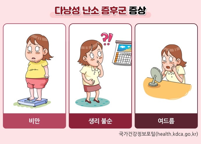 다낭성난소증후군/다낭성난소증후군증상/원인/진단/치료방법/