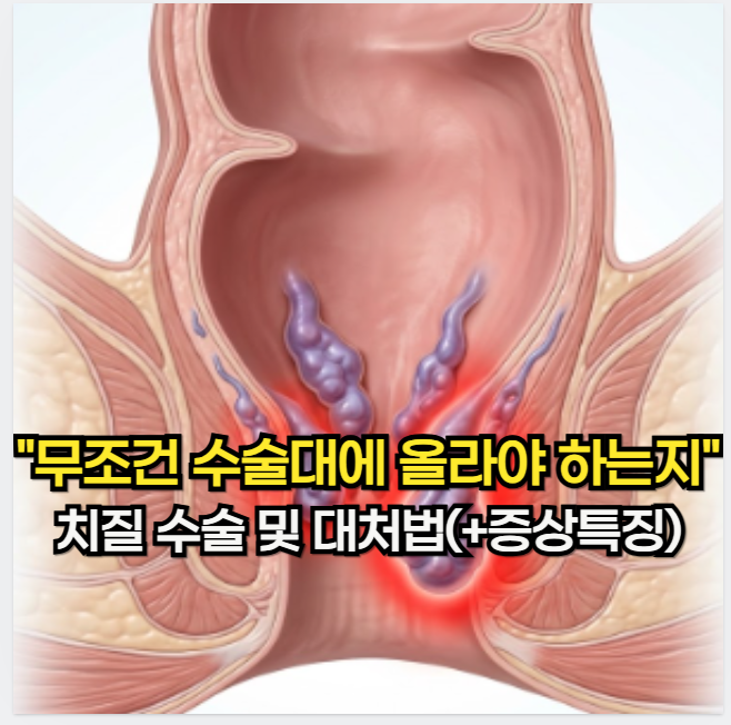 치질 증세, "무조건 수술대에 올라야 하는지" 팩트 체크 치질 수술 및 대처법