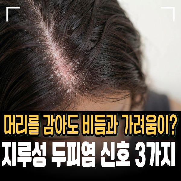 머리를 감아도 비듬과 가려움이? 지루성 두피염 신호 3가지