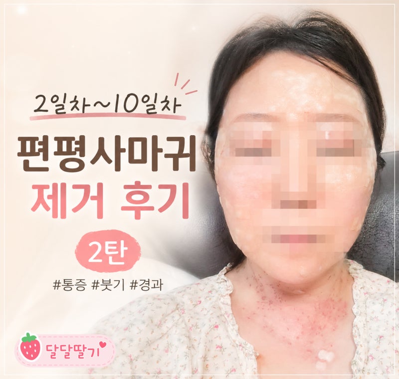 편평사마귀 제거 후기 ② | 2일차~10일차 경과 기록 (붓기, 가려움, 색소침착)