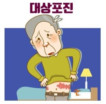 대상포진 증상과 치료 꼭 알아두세요.