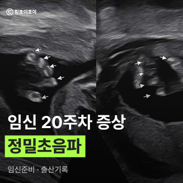 임신 20주차 호산병원 정밀초음파 후기, 20주차 증상(태동, 꿈, 귀 먹먹함, 꼬리뼈 통증)