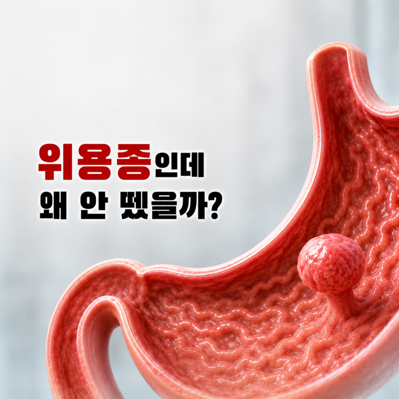 위용종 왜 안 떼나요? 조직검사만 하는 이유