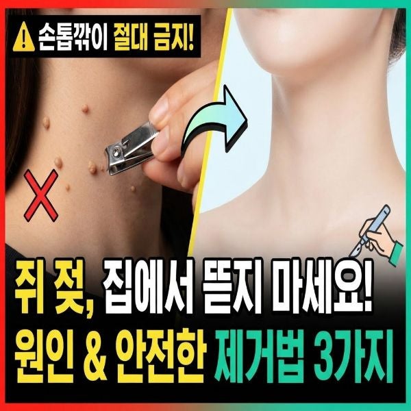 손톱깎이로 쥐젖을? 쥐젖 생기는 원인과 안전한 제거법 3가지