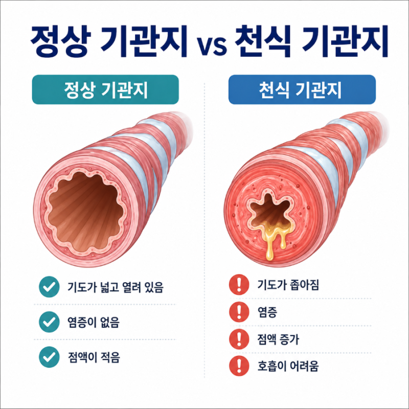 천식 증상, 원인, 치료, 흡입기, 약 등 핵심정리