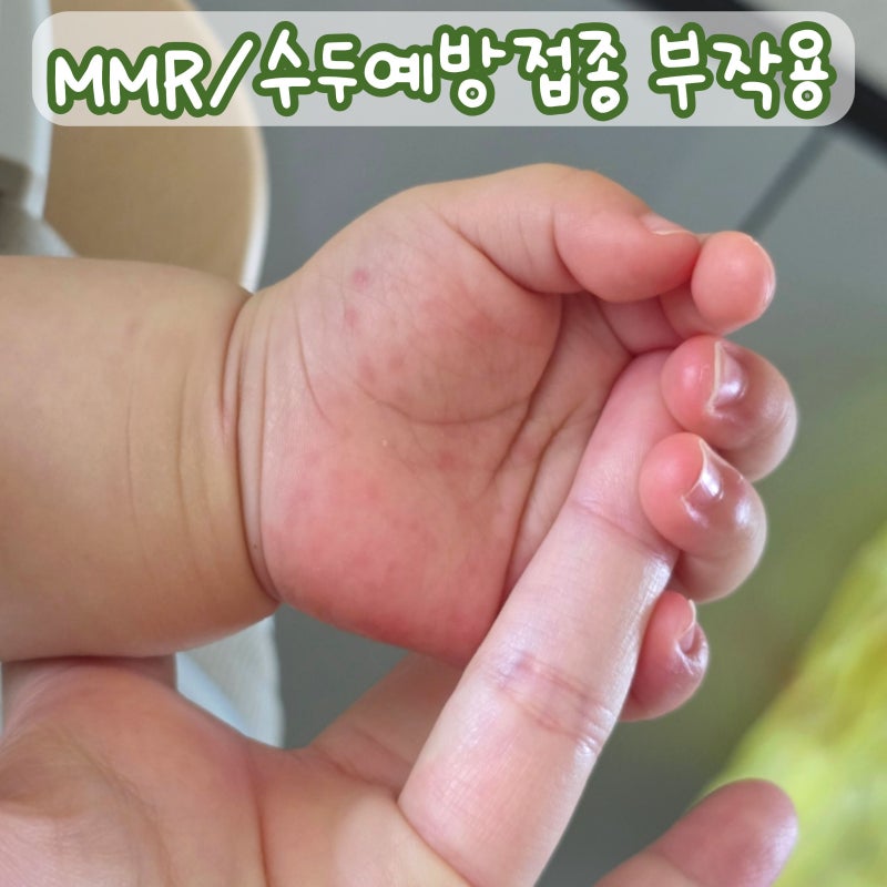 돌아기 예방접종 부작용 MMR,수두접종 후 수두/수족구의심/발진/접종열 후기