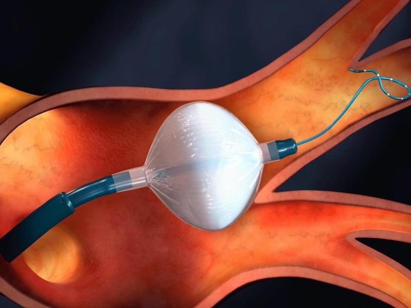 냉동풍선절제술(Cryoablation)이란?