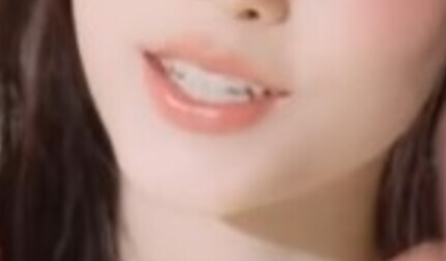사라졌던 송곳니가 약 한 달 만에 다시? 뉴진스 해린 치아 논란 복구, 라미네이트설의 반전