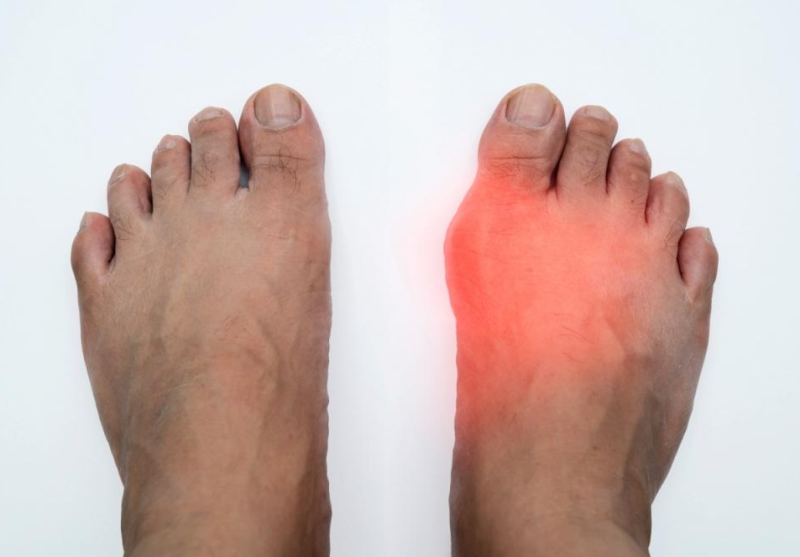 통풍에 안 좋은 음식 10가지, 이것만 줄여도 요산 관리에 도움이 될까?