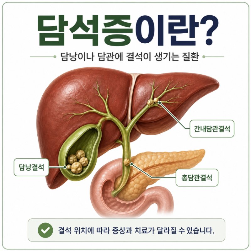 담석증 증상, 원인, 통증, 치료, 수술, 약, 음식 관리 등 핵심정리