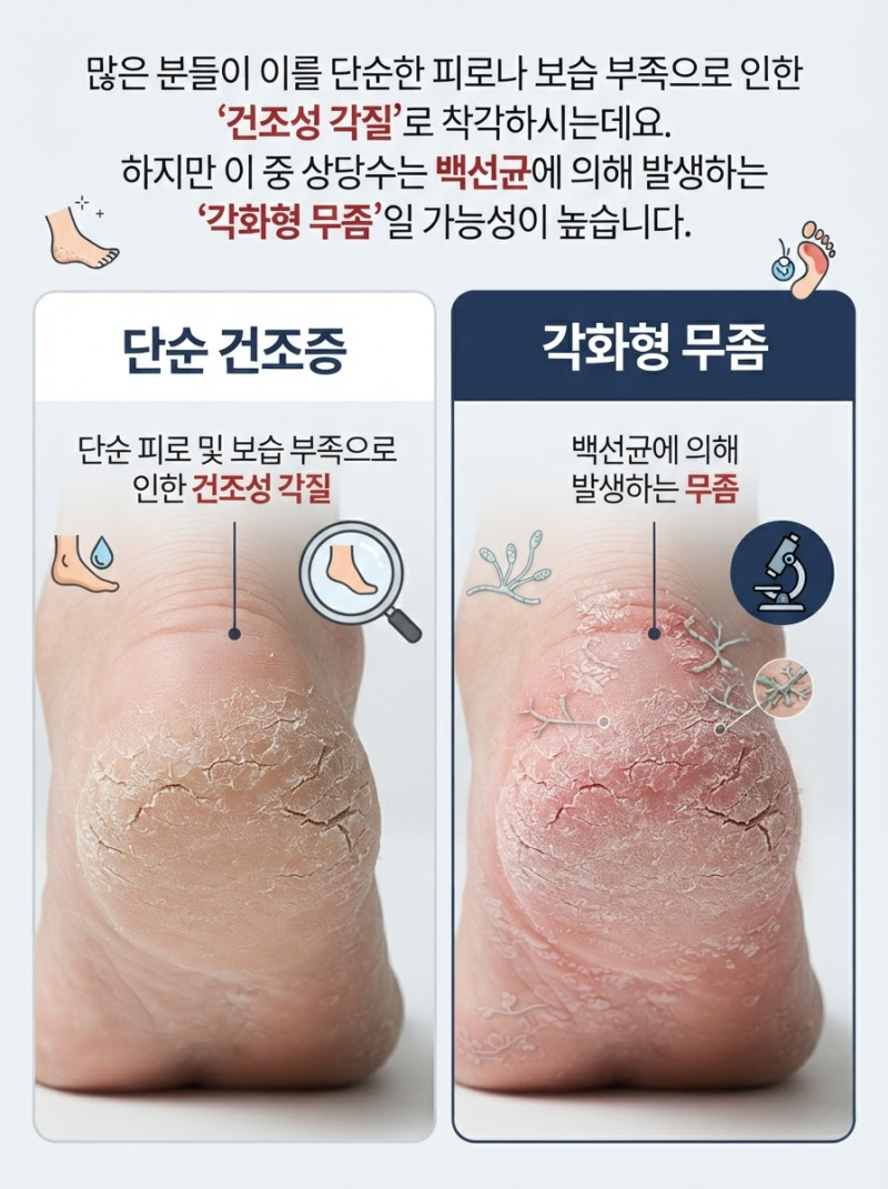 단순 발각질 vs 발바닥 무좀증상 차이점 완벽 비교! 무좀원인 파악 및 발톱무좀 연고 치료법