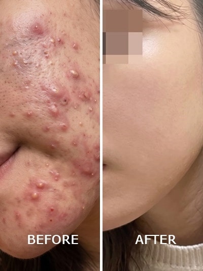 모낭염 치료_원인부터 초기 증상, 해결 방법까지