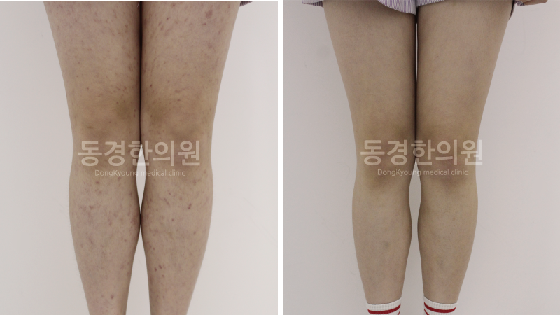 허벅지 붉은 반점 좁쌀 만한 빨간 점들이 많아진다면