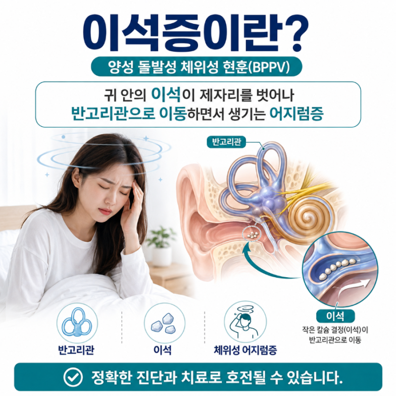 이석증 증상, 원인, 치료, 약, 에플리법, 어지럼증 등 핵심정리