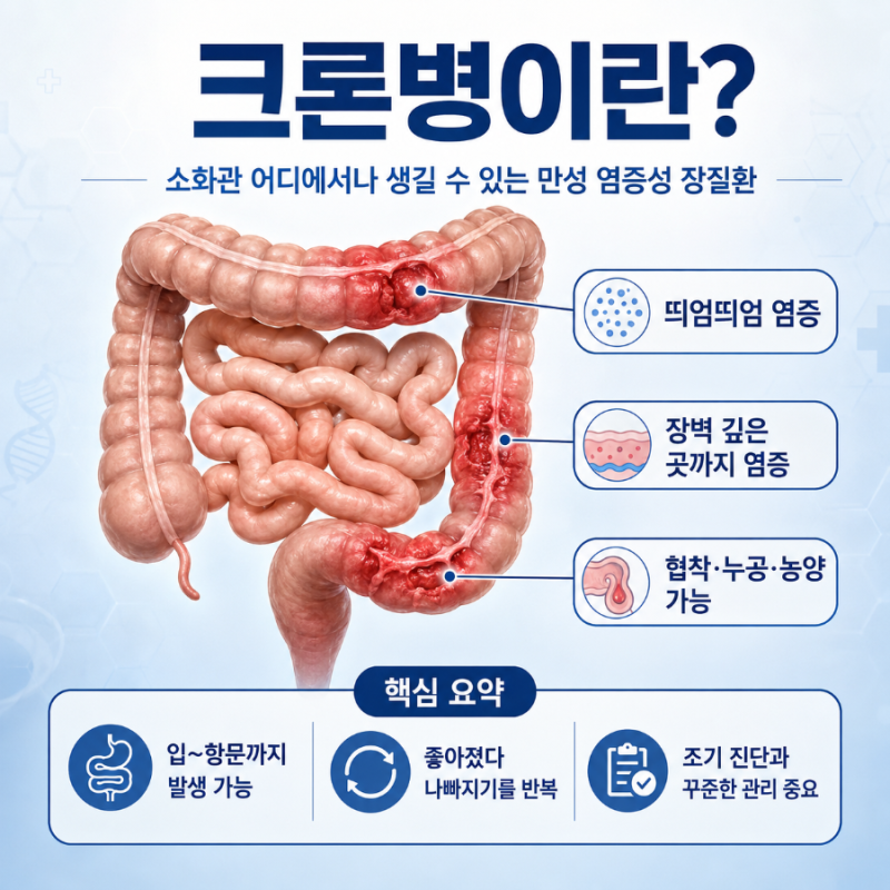 크론병 증상, 원인, 치료, 검사, 완치, 음식 관리 등 핵심 정리